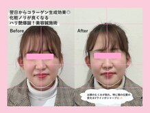 本厚木鍼灸整骨院/【美容鍼】施術前後