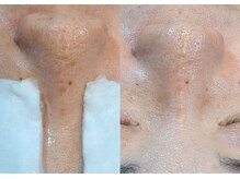 アースコアフュールボーテ ひたち野うしく店(EARTH coiffure beaute)/光フェイシャル1回での結果◎