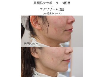 Beauty salon TCM 【小顔/たるみ/バストアップ】/顔の筋肉運動が自動で出来る