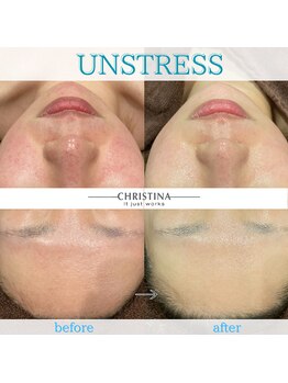 ダリアビューティー(Dahlia Beauty)/アンストレス before after