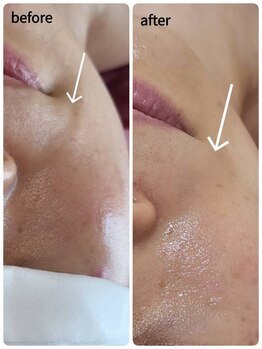 ピウリ(PIURI)/Before→After ほうれい線改善♪