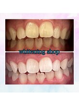 ホワイトニングショップ 奈良香芝店(Whitening shop)/効果抜群ホワイトニング