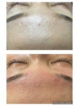 エンユイ 横浜 元町(EnnYui)/美容電気眉毛脱毛　眉毛デザイン