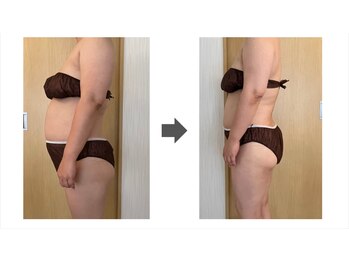 ルルラ(Rulula)/痩身ダイエット施術前後4