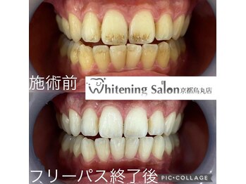 ホワイトニングサロン 京都烏丸店/ホワイトニングサロン施術例
