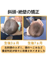 高山整骨院/赤ちゃんの頭の形矯正