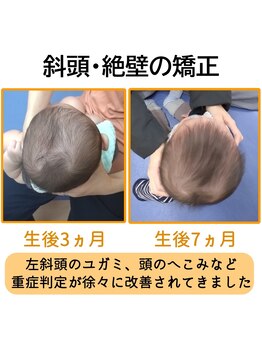 高山整骨院/赤ちゃんの頭の形矯正