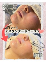 ボーテドゥマリエ(beaute de mariee)/フェイシャルビフォーアフター