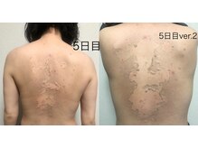 リベル 名古屋(Lebelle:)/ハーブピーリング専門名古屋