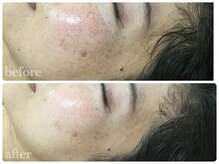 光フェイシャル1回★悩んでた肌トラブル1回でここまで改善！！