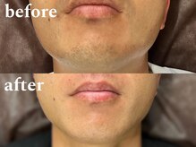 ボス 津店(BOSS)/【メンズ脱毛/ヒゲ脱毛】