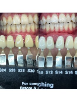 トウキョースワーズ 渋谷店(TOKYO SWRS)/#ホワイトニング #渋谷 #池袋