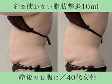 ソルニス(Solnis.)/痩身☆脂肪分解/ハイパーナイフ