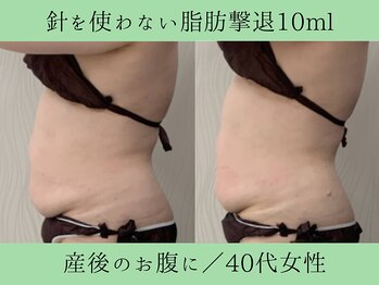 ソルニス(Solnis.)/痩身☆脂肪分解/ハイパーナイフ