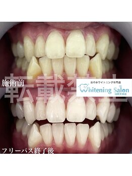 ホワイトニングサロン 福岡天神店/ホワイトニング