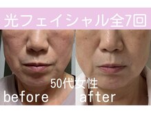 キワミ サーティスリー(kiwami33)/フォト照射ビフォーアフター