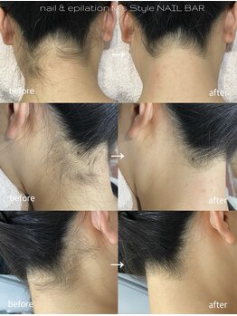 エムズスタイル ネイルバー(M's Style NAIL BAR)/うなじ脱毛
