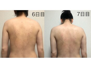 リベル 名古屋(Lebelle:)/ハーブピーリング専門名古屋