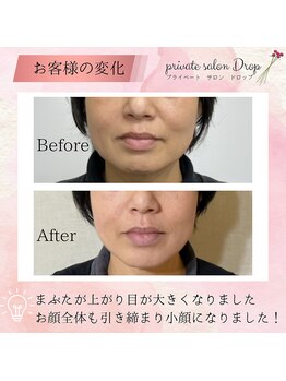 ドロップ(Drop)/50代　小顔矯正　顔幅すっきり！