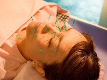 あおば鍼灸整骨院の雰囲気（完全個室のプライベート空間♪人気の美容鍼メニューもあります☆）