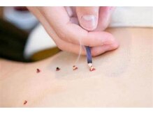 ムーン(Moon)/お灸