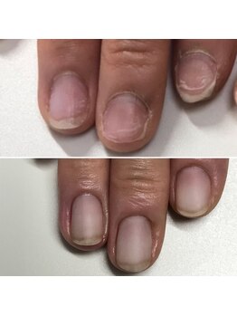 弱くボロボロの爪も綺麗に