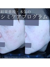 アウラプラス(Aura+)/塗るだけシミケア症例/1年