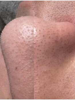 マルク(MARQUE)/毛穴パック