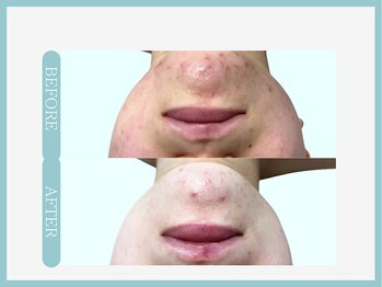 アコガレコガオ 青森店/