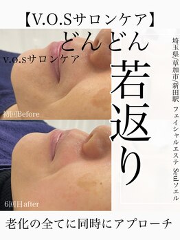ソエル(Seul)の写真/シミ、シワ、たるみ、浮腫み、くすみ、顔肥大まで。老化現象の全てに同時にアプローチ。高リピート率!