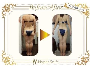 カワイ ビューティーサロン 新宿西口店(Kawai Beauty Salon)/【ハイパーナイフ】before/after