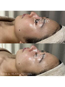 サロン ド ブラン アオヤマ(Salon de BLANC AOYAMA)/ビオフィート×ソノケア70分