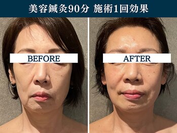 シンク(CINQ)/美容鍼灸60分むくみ解消小顔矯正