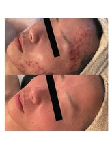 クロム(CHROME)/水光ピーリング　肌質改善