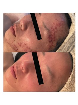 クロム(CHROME)/水光ピーリング 肌質改善