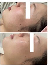 エステティックレイビス 名古屋店(RAYVIS)/小顔＋美白へ導くスペシャルケア