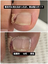 巻き爪じゅん 千葉駅前店/巻き爪・陥入爪に痛みが改善！