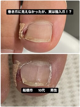 巻き爪・陥入爪に痛みが改善！
