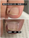 巻き爪・陥入爪に痛みが改善!