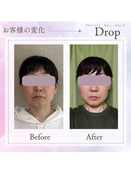 ドロップ(Drop)/30代　エラ張り解消