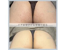 熊本初の美尻特化ケア最新機器×熟練の技でモチっぷりんお尻に◎