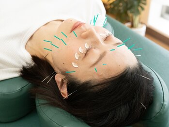 エル鍼灸整骨院の写真/【4月は第一印象アップ】むくみ・くすみ・たるみに◎美容鍼で内側から整える