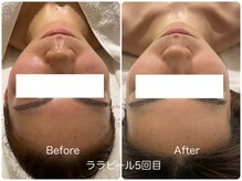 イデアルミー 大宮店(イデアルMe)/小顔・ハーブピーリング・毛穴
