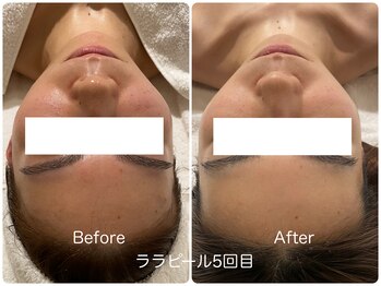 イデアルミー 大宮店(イデアルMe)/小顔・ハーブピーリング・毛穴