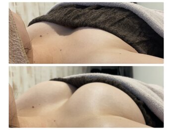 モナンジュ(ramonange)/バストアップbefore after