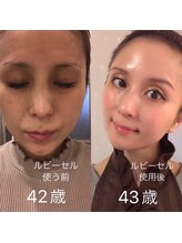 ナナラ(nanala)/オーナー自身のお肌変化