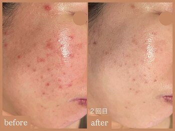 リムーン 岡崎(Re'moon)/REVI ハーブピーリング