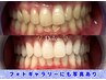 【学割U24】【2回目以降もお得に！】プラチナムホワイトニング15分×3照射♪