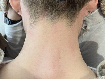 フェリモール(Felimor.)の写真/最先端マシンを導入★デリケートな「VIO」や男性の「ヒゲ」等減りづらい箇所へも優秀な効果を発揮します！