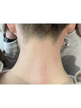 脱毛デビューにオススメのサロン